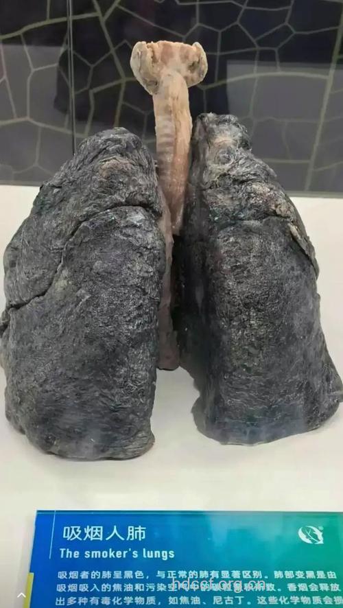 肺癌让人迷惑的肺外表现