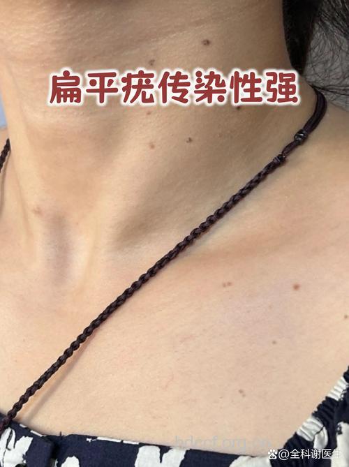 扁平疣传染性强