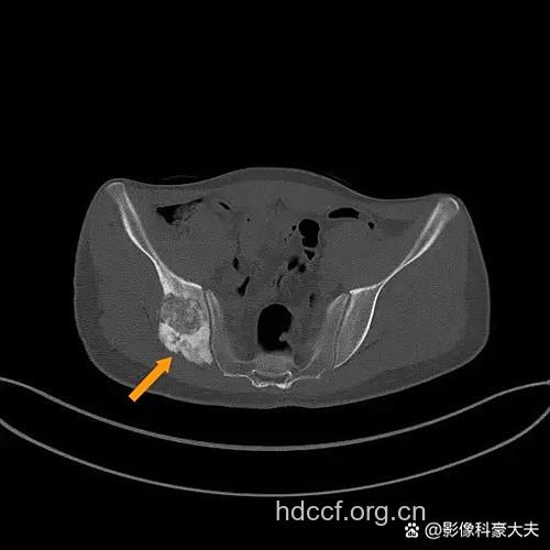 椎管内肿瘤误诊分析