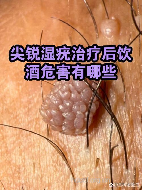 尖锐湿疣不能喝酒
