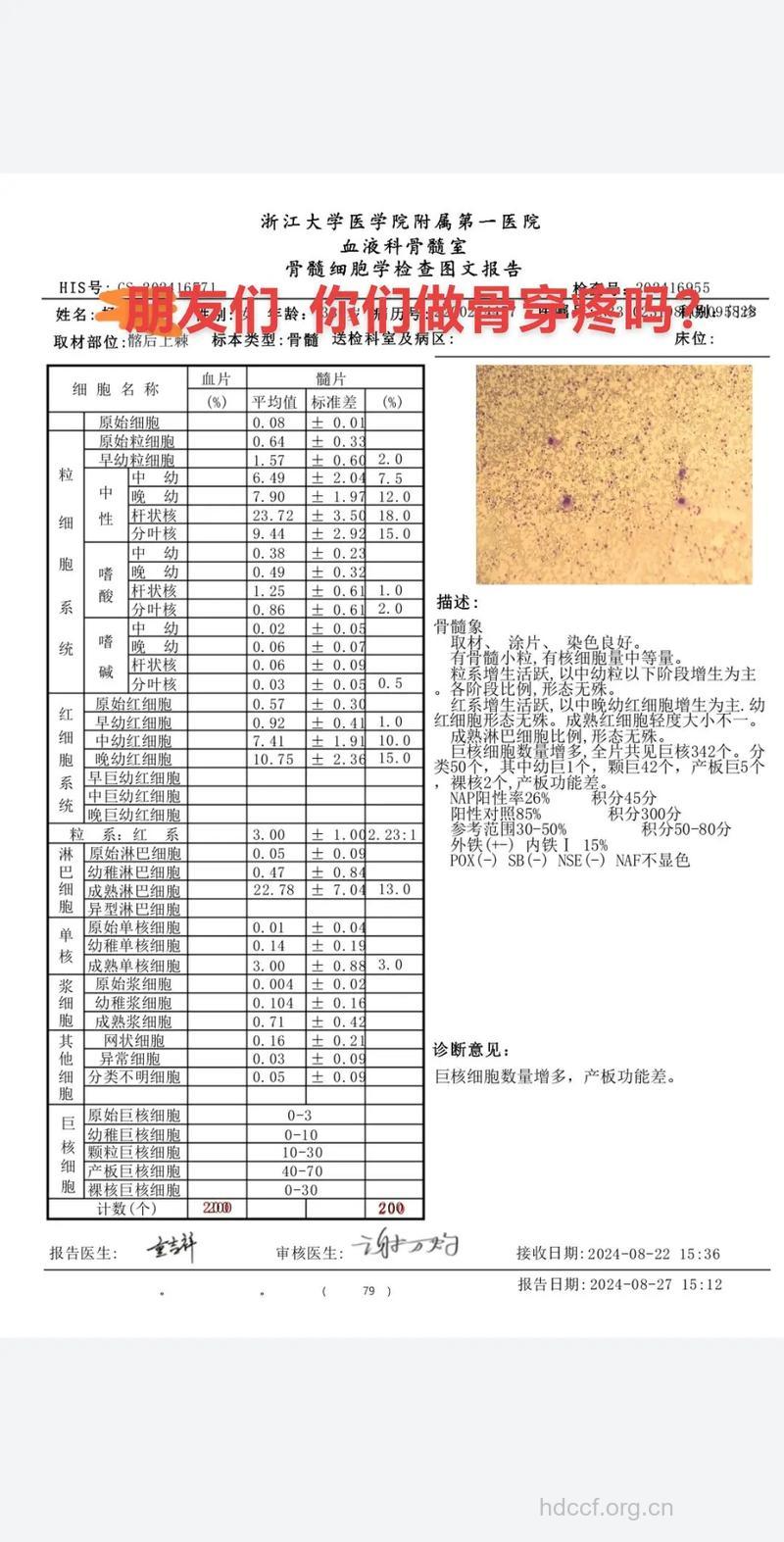 白血病后反复骨穿为何?