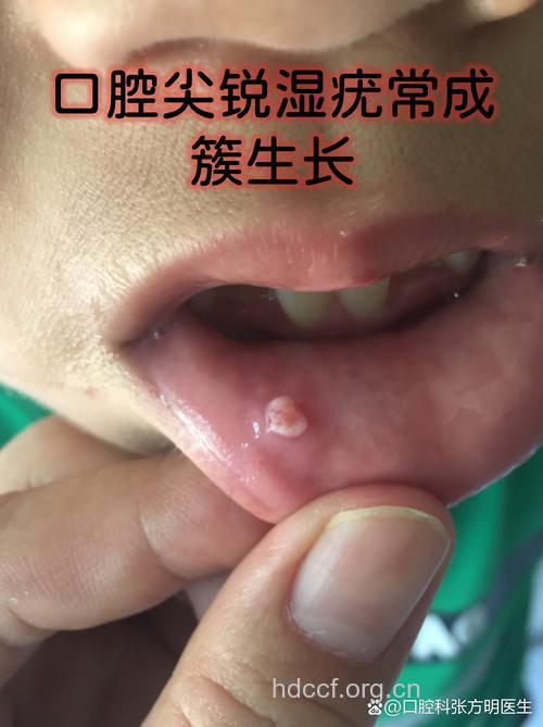 口交、性伴侣多易患尖锐湿疣