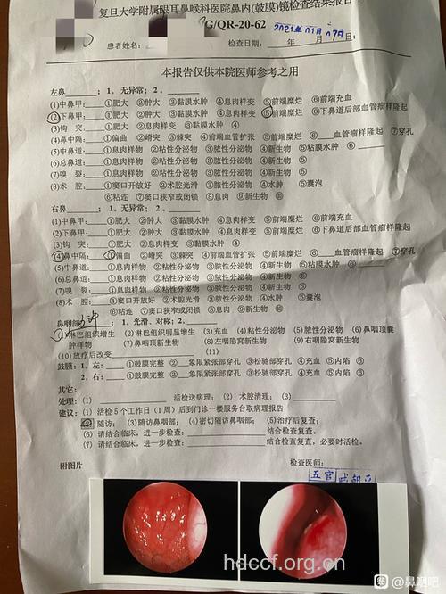 确诊鼻咽癌要做哪些检查