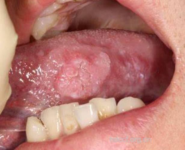 口腔癌的4大常见症状