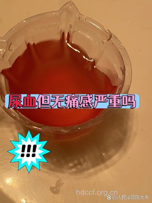 中老年人无痛性血尿慎肾癌