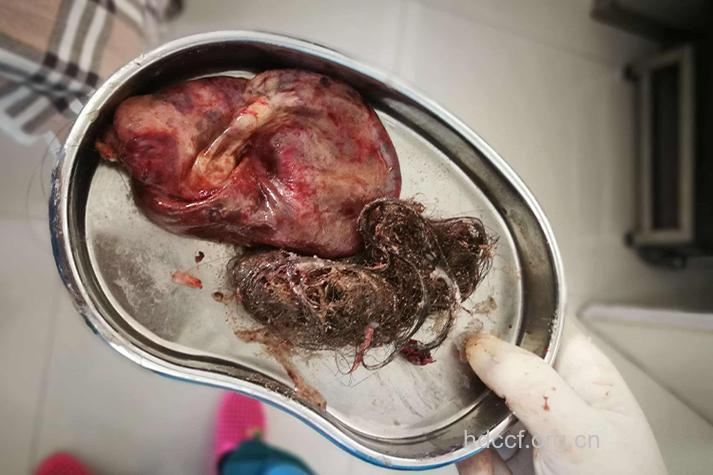 畸胎瘤的真相是肿瘤