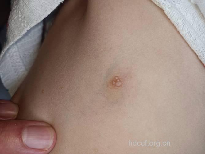 小心儿童惹上传染性软疣