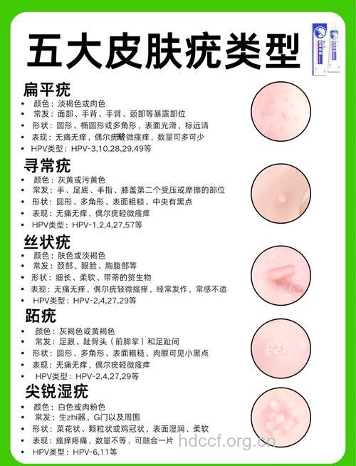 分类叙述疣的临床症状