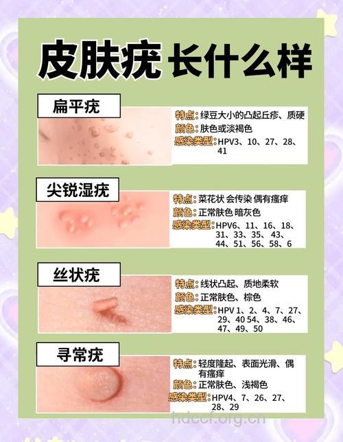 如何确诊扁平疣？