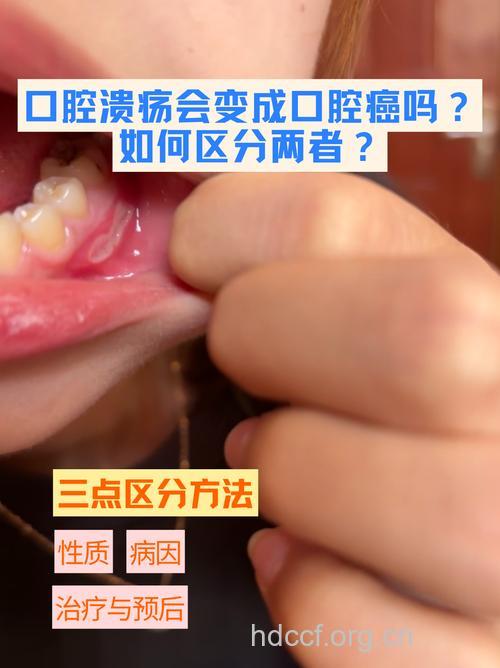 口腔溃疡或是癌