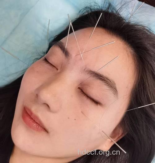 中医针灸能去眼袋