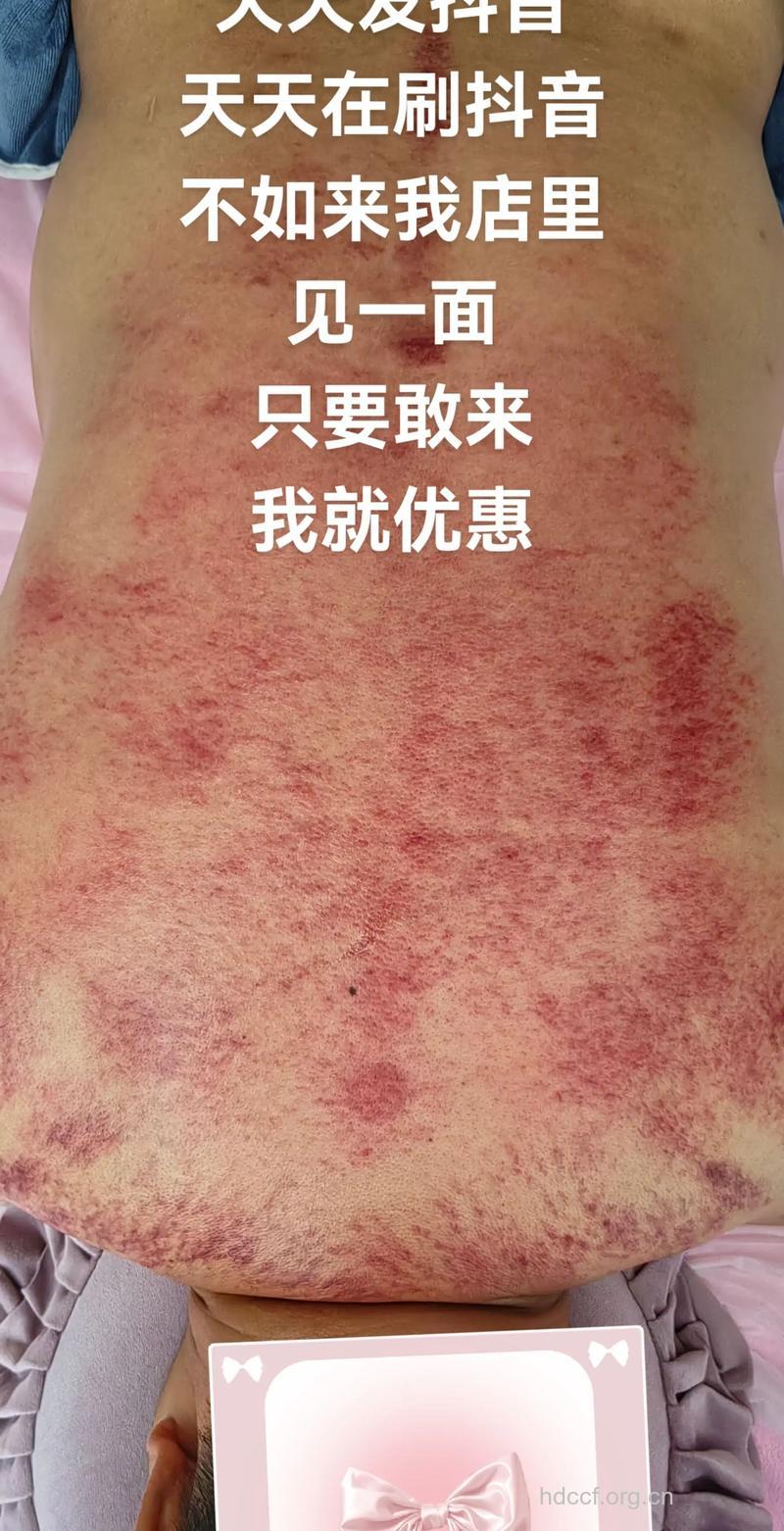 刮痧治感冒 刮痧更适合风寒感冒