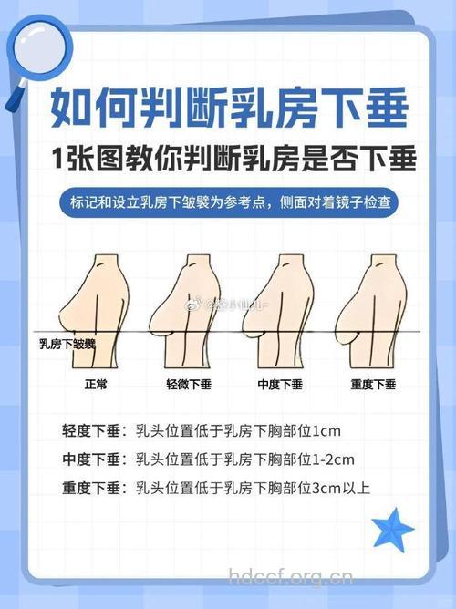 如何自测女性乳房下垂?
