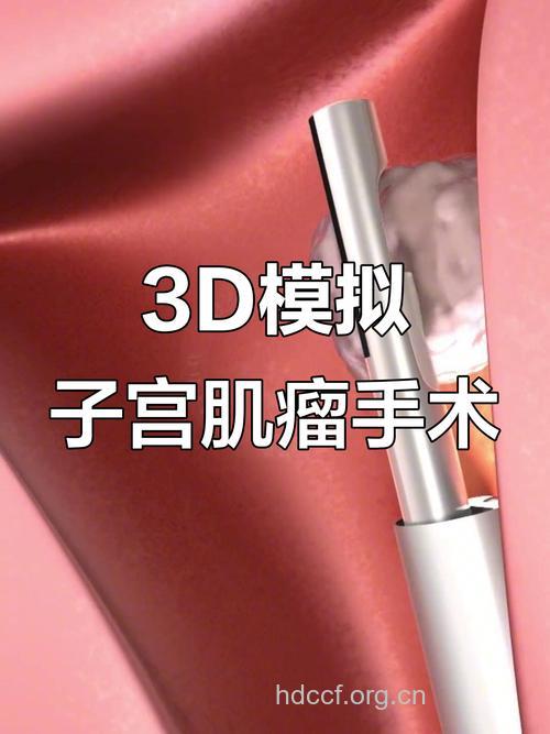子宫肌瘤什么情况需要手术