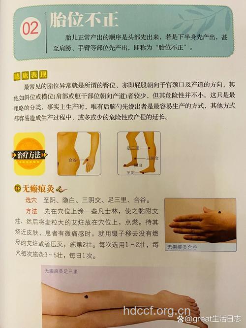 胎位异常的中医针灸治疗方法