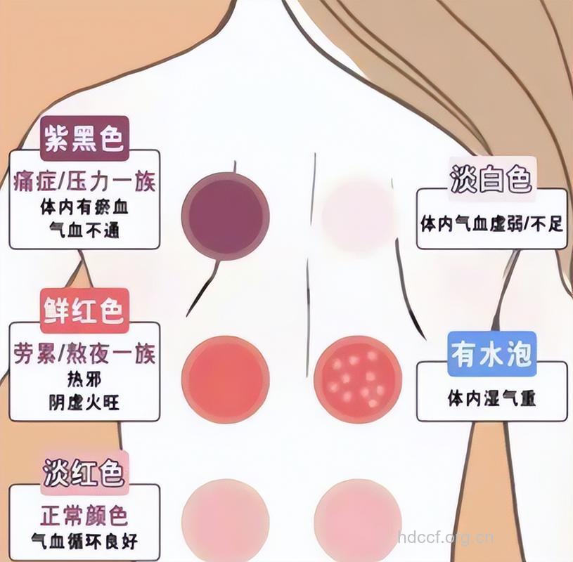中医教你从拔罐出血情况看身体疾病