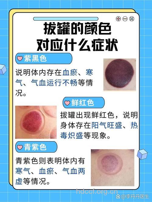 拔火罐后有哪些颜色