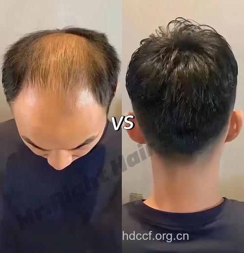 想成为肌肉男需警惕脱发