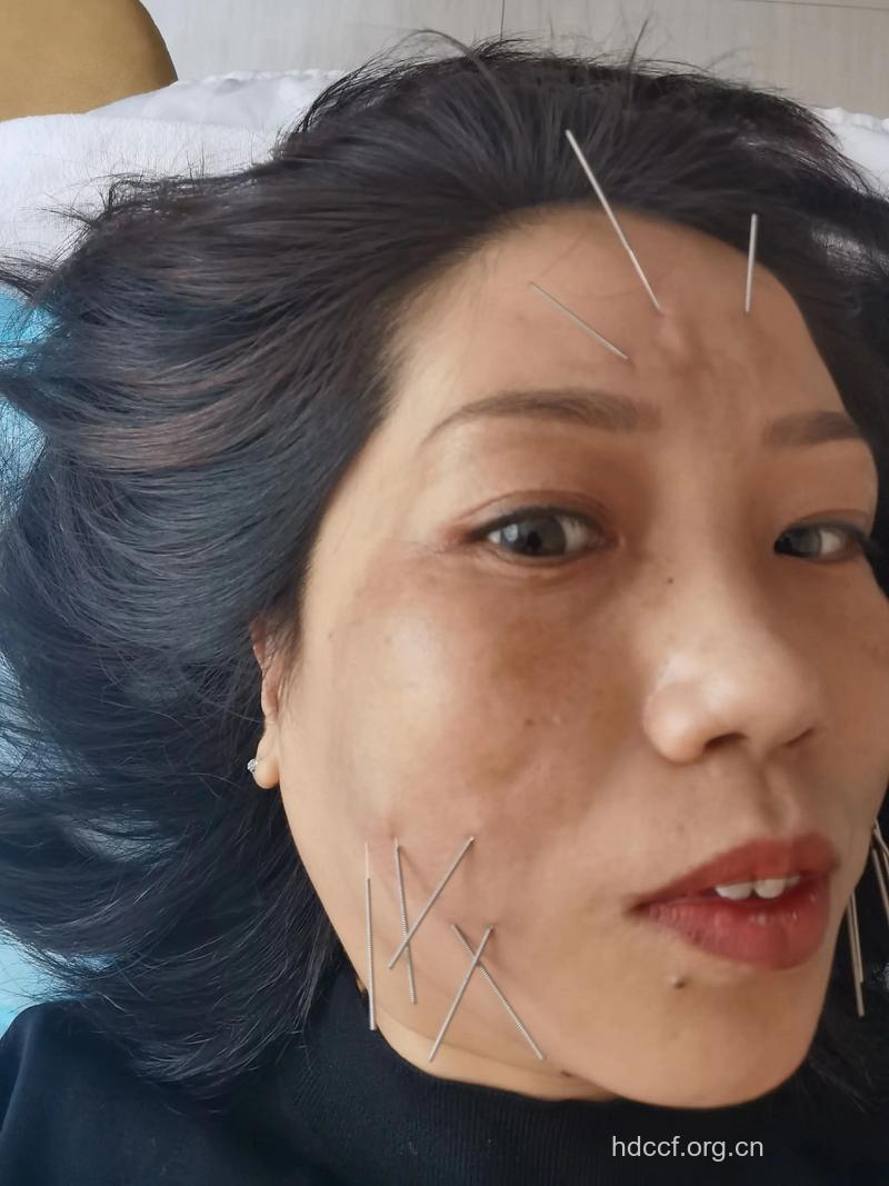 针灸治疗黄褐斑的方法
