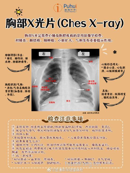 哪些人需常复查胸片排除肺癌?
