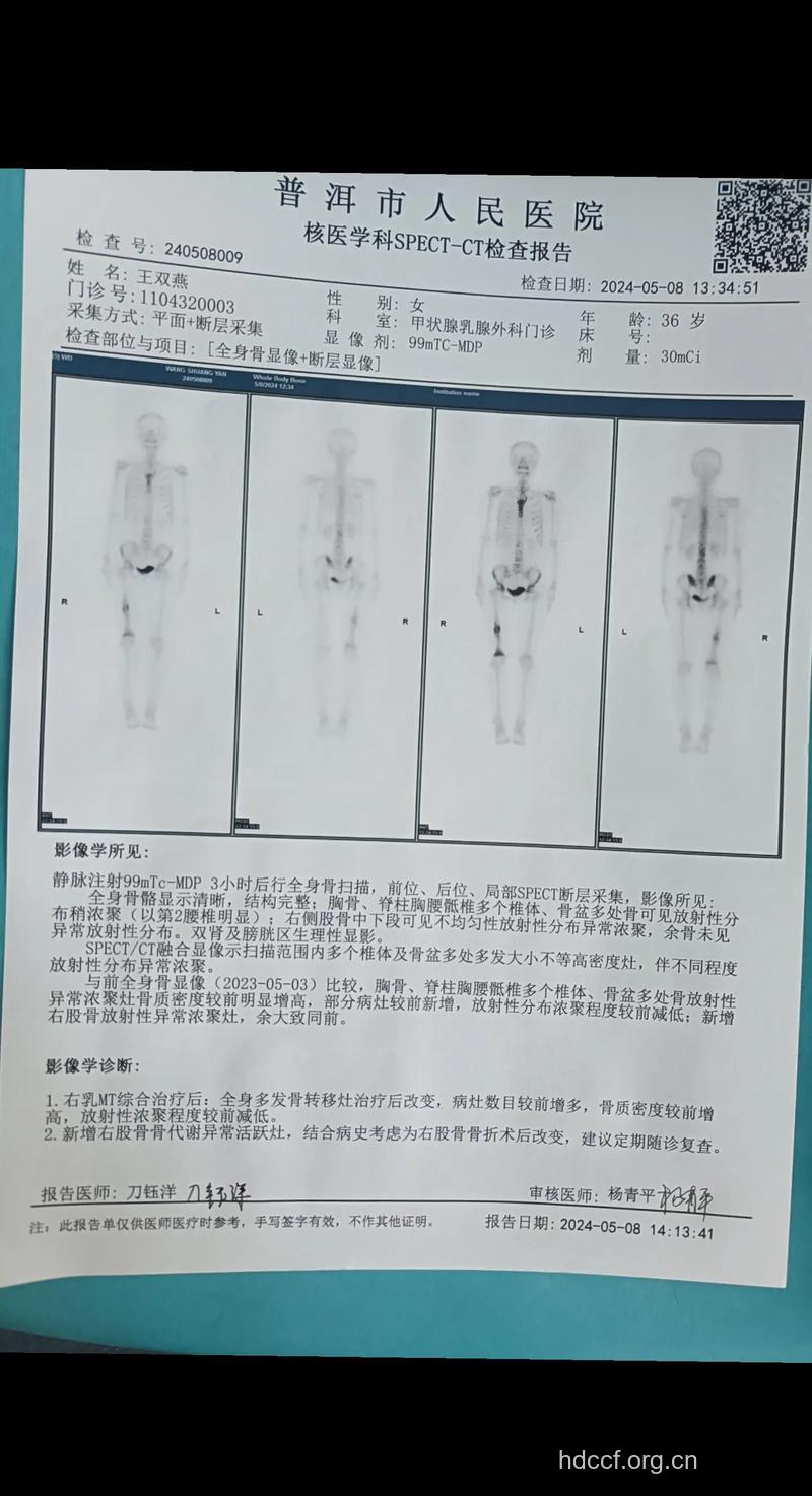 诊断骨癌需做哪些检查?