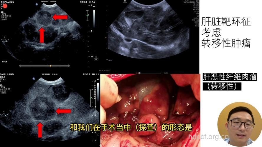 超声可检查出哪些恶性肿瘤?