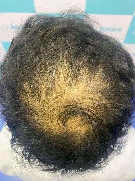 维生素A摄入过量致脱发