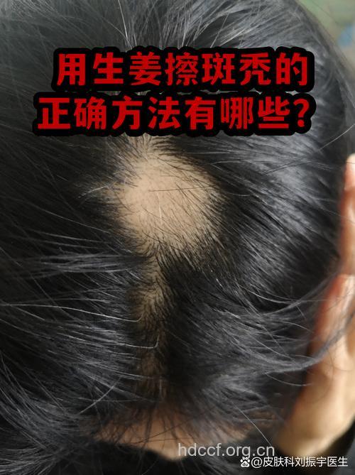 治疗斑秃 不能乱抹生姜