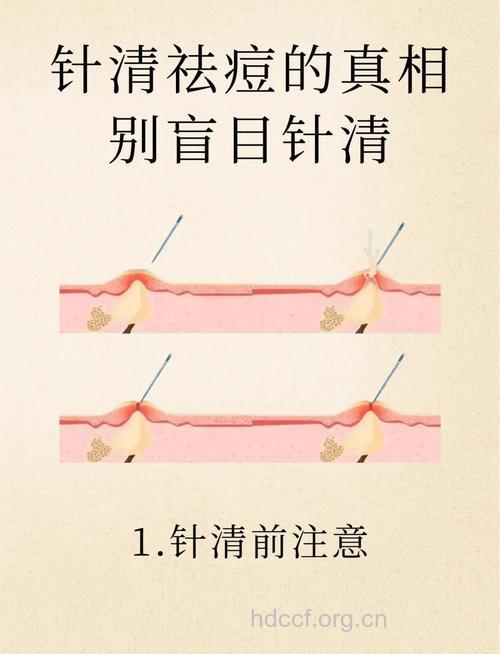 中医针灸祛痘的原理