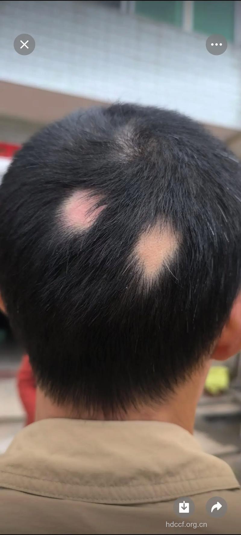 斑秃患者需要警惕眼疾来袭