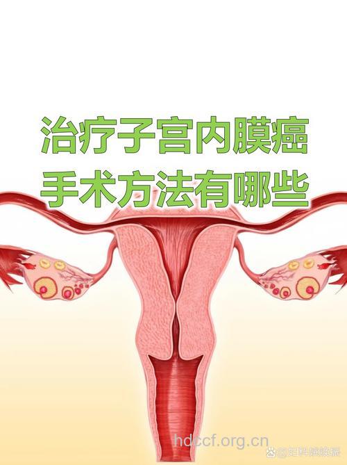 早期子宫癌可不行手术治疗