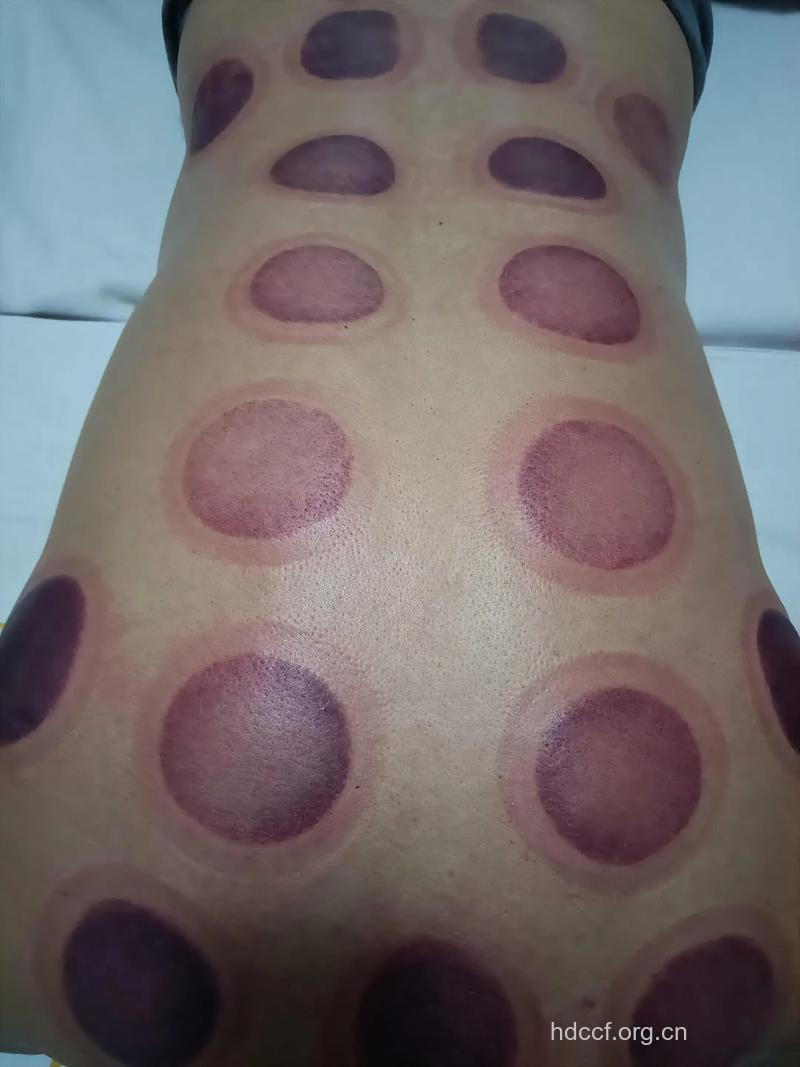 拔火罐留下痕迹正常吗
