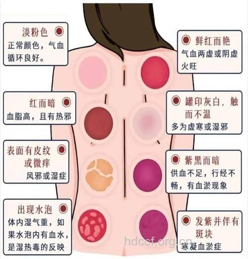 拔罐后皮肤的颜色告诉你身体情况