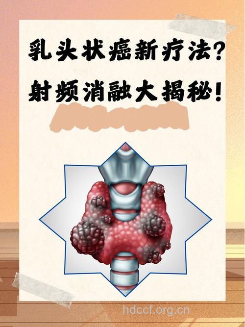 甲状腺乳头状癌您知多少?