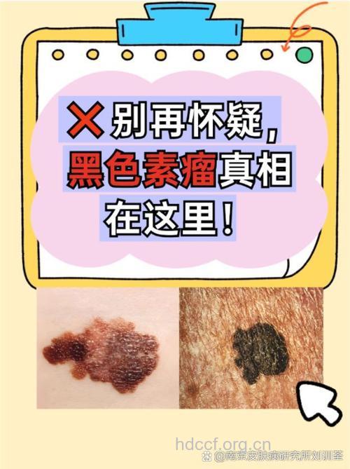 哪些因素影响黑色素瘤的预后?