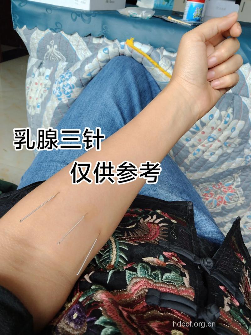 针灸治疗乳腺增生的方法
