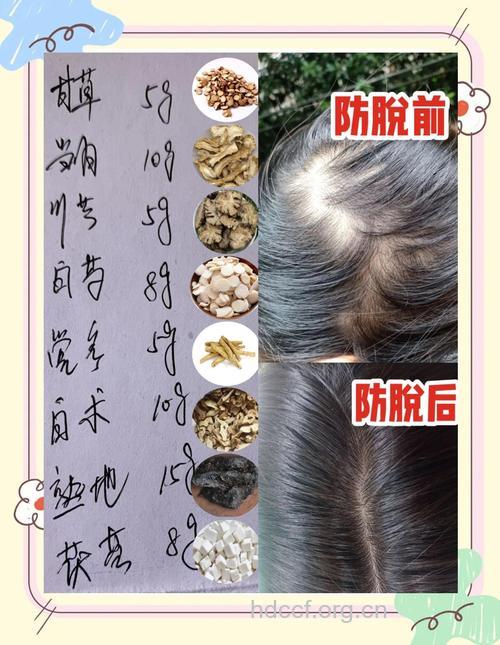 中医良方解除脱发之烦恼