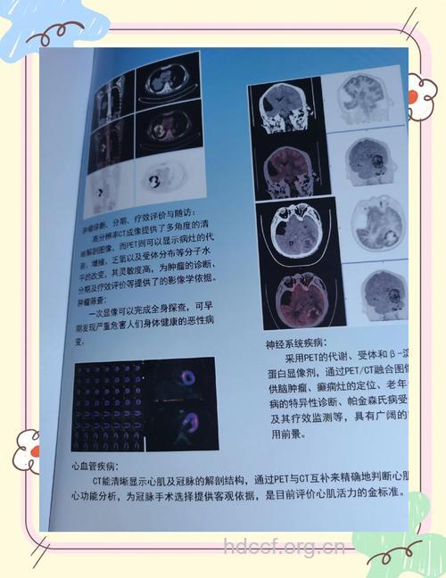 PET检查和肿瘤诊断
