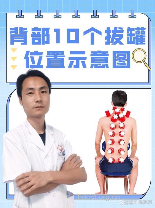 中医怎么拔罐治疗后背疼痛