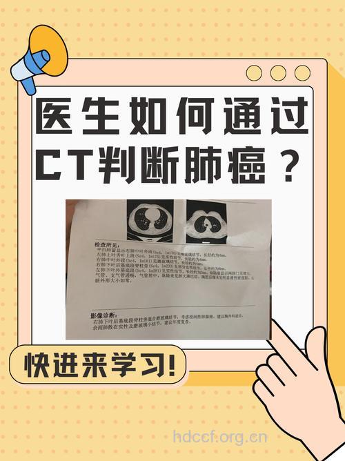 解读CT诊断肿瘤优点与不足