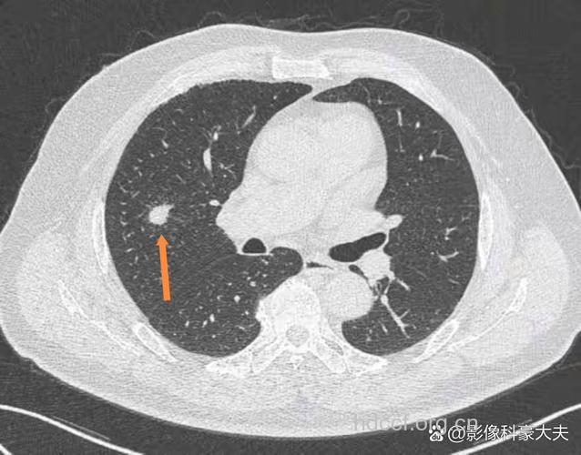 一次性筷子容易导致肺癌