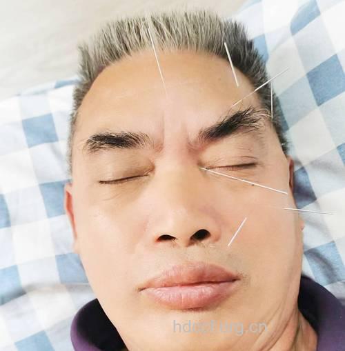 中医怎么针灸治疗老年干眼症