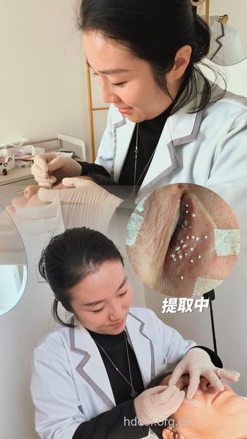 中医怎么针灸治疗汗管瘤