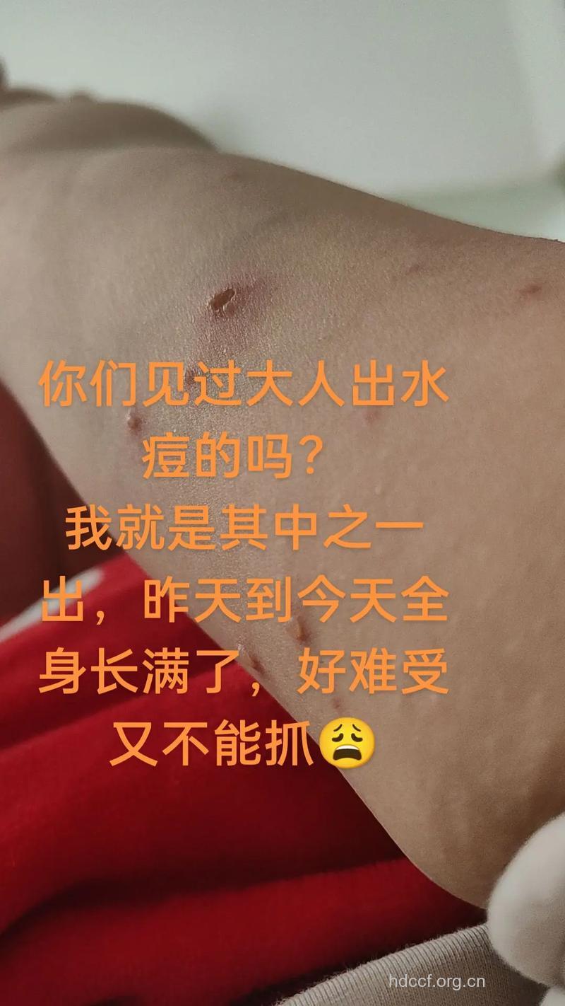 怎么针灸治疗孕期水痘