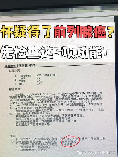 早期前列腺癌检测弊大于利