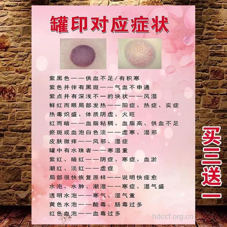 中医怎么拔罐治疗白癜风