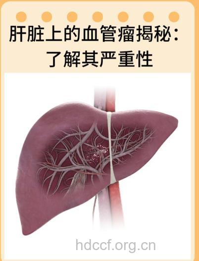 肝血管瘤 良性恶性定要分清