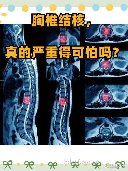 易被误诊为癌症的脊柱结核