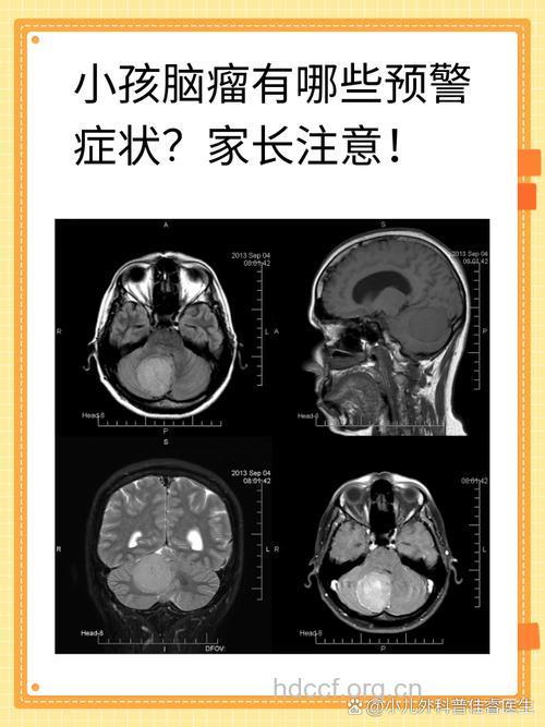 容易被忽视的儿童脑瘤