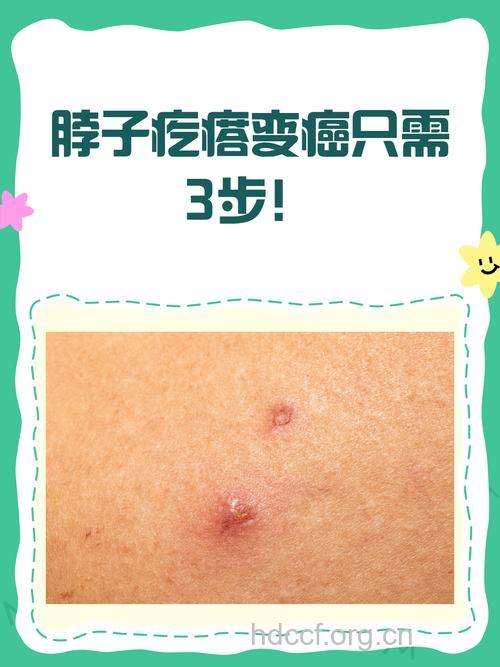 癌症的皮肤征兆